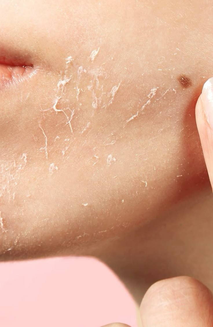Skin treatment