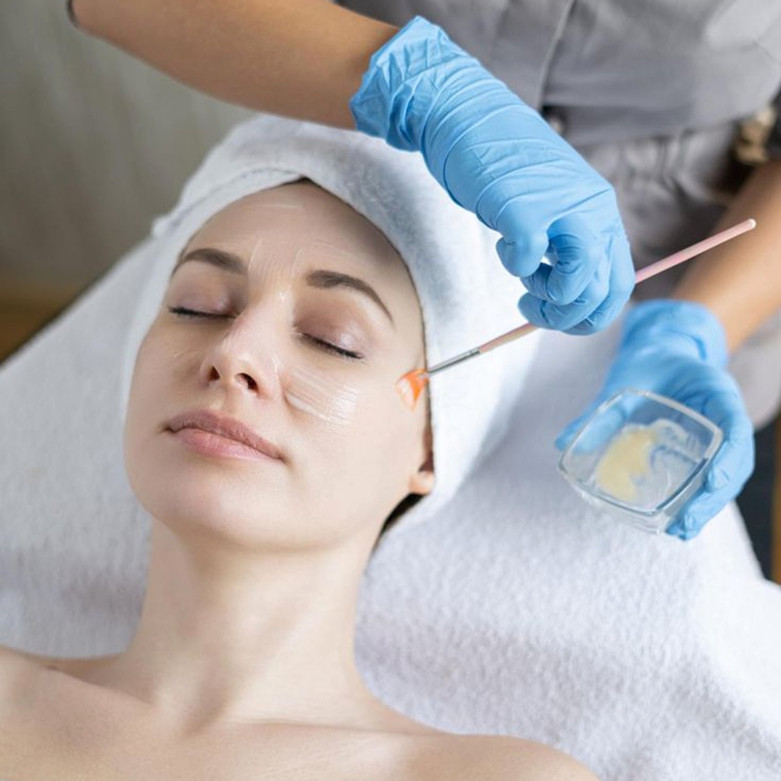 Chemical Peels
